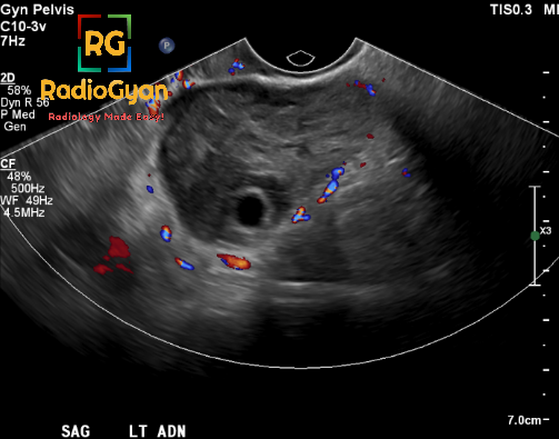 TeamRadioGyan's tweet photo. Hx: Severe pelvic pain. Diagnosis? 
Answer and Discussion : https://t.co/YRcuM3YTBP

 #RGcases #radiogyan #radiology #radres #radiologia #FOAMrad #FOAMed https://t.co/NOcfURmOHp