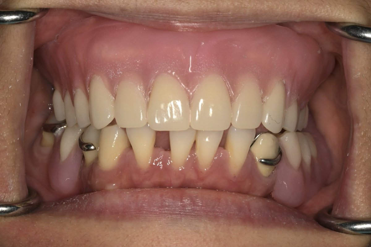 Combination Case 

Upper Complete Denture
Lower RPD with surveyed crown on #33
