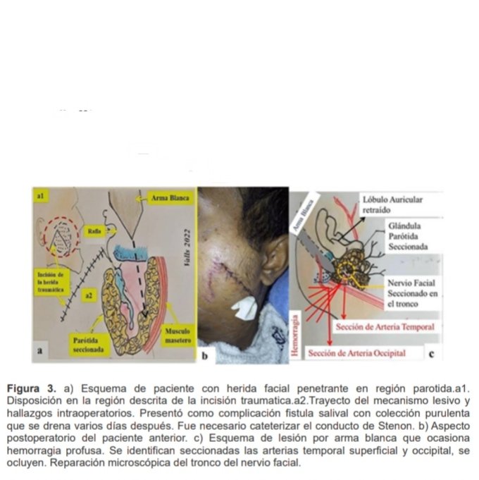 cabeza_cuello's tweet photo. Interesante artículo: 
Manejo inicial de los traumatismos faciales penetrantes
Dr. Juan Carlos Valls https://t.co/BnNbduD8pp