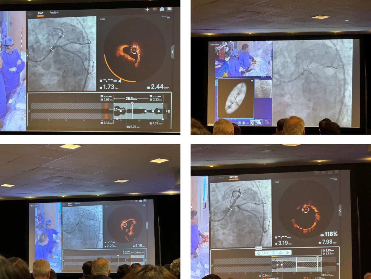 ShockwaveIVL's tweet photo. Great live case to kick off #CRT2024! Dr. @DrAllenJ & Richard Shlofmitz treated a 82 y/o female with a calcified nodule in the prox LAD. They used 80 pulses of #ShockwaveC2plus to crack the nodule & stented for an incredible result.
US Rx only. ISI https://t.co/sZ0NdzXNcV https://t.co/orsvnrNu8S