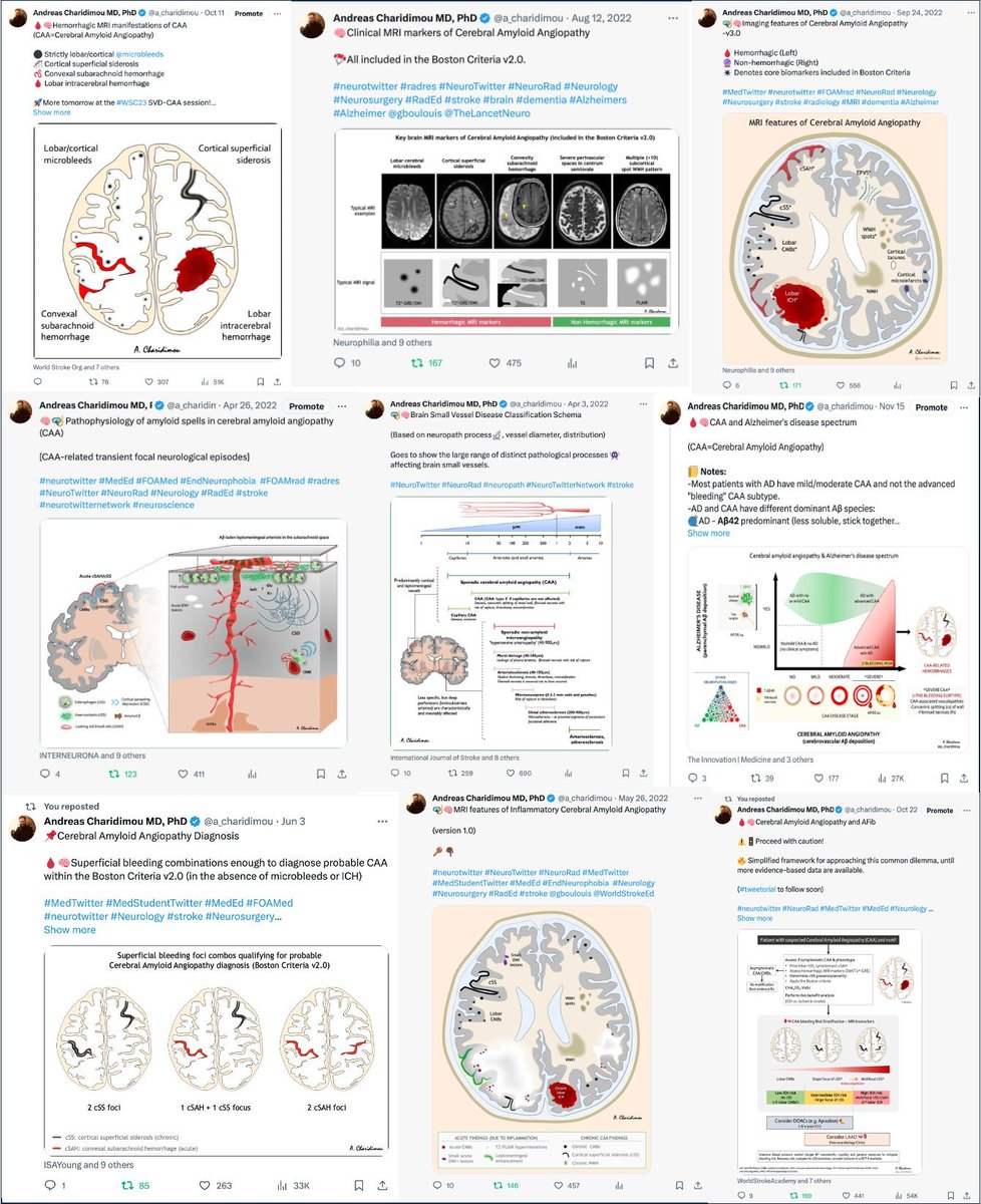 🧵👇Cerebral Amyloid Angiopathy🩸🧠 Illustrations and tweetorials on CAA, SVD and related disorders by @a_charidimou #NeuroTwitter #stroke #Neurology #neuropath #stroke #dementia #Alzheimers #biomarker #brain #MedStudentTwitter #AmyloidAngiopathy #CAA #cSVD