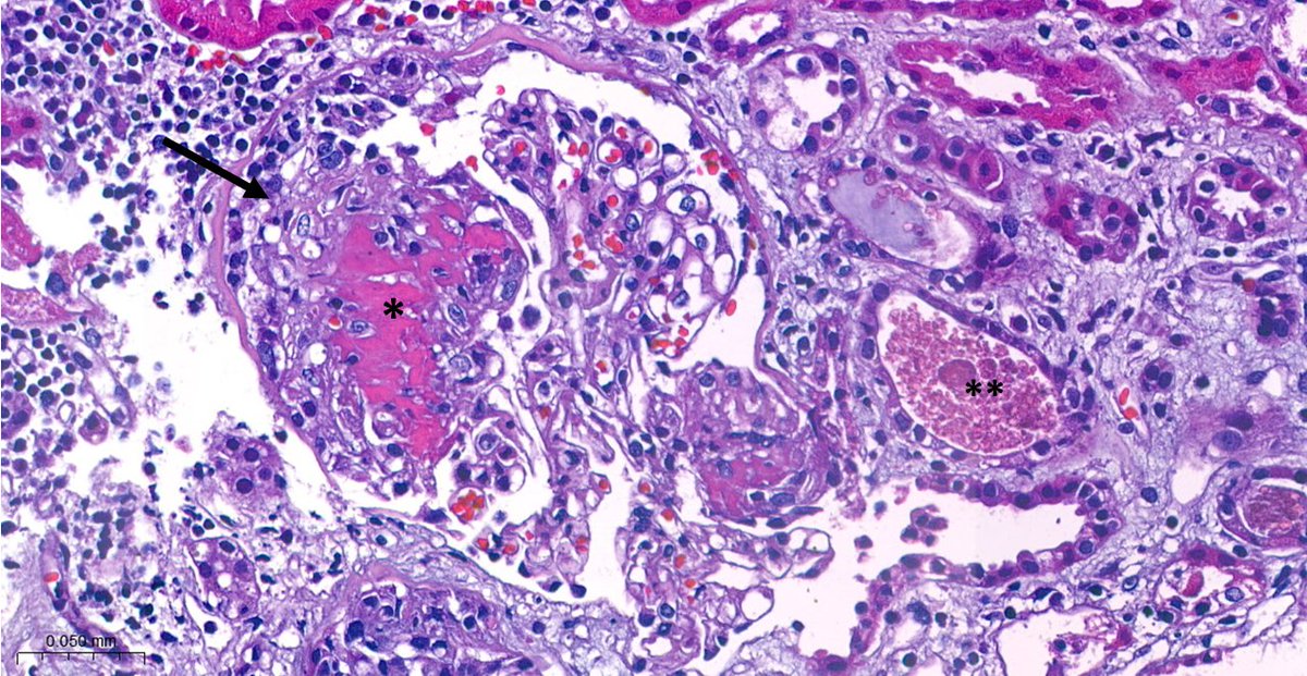 Hematoxylin & eosin section demonstrates fibrinoid necrosis (*) and cellular crescent (arrow) in a glomerulus. Red blood cell cast noted (**) #ANCAGN #pauciGN #renalpath