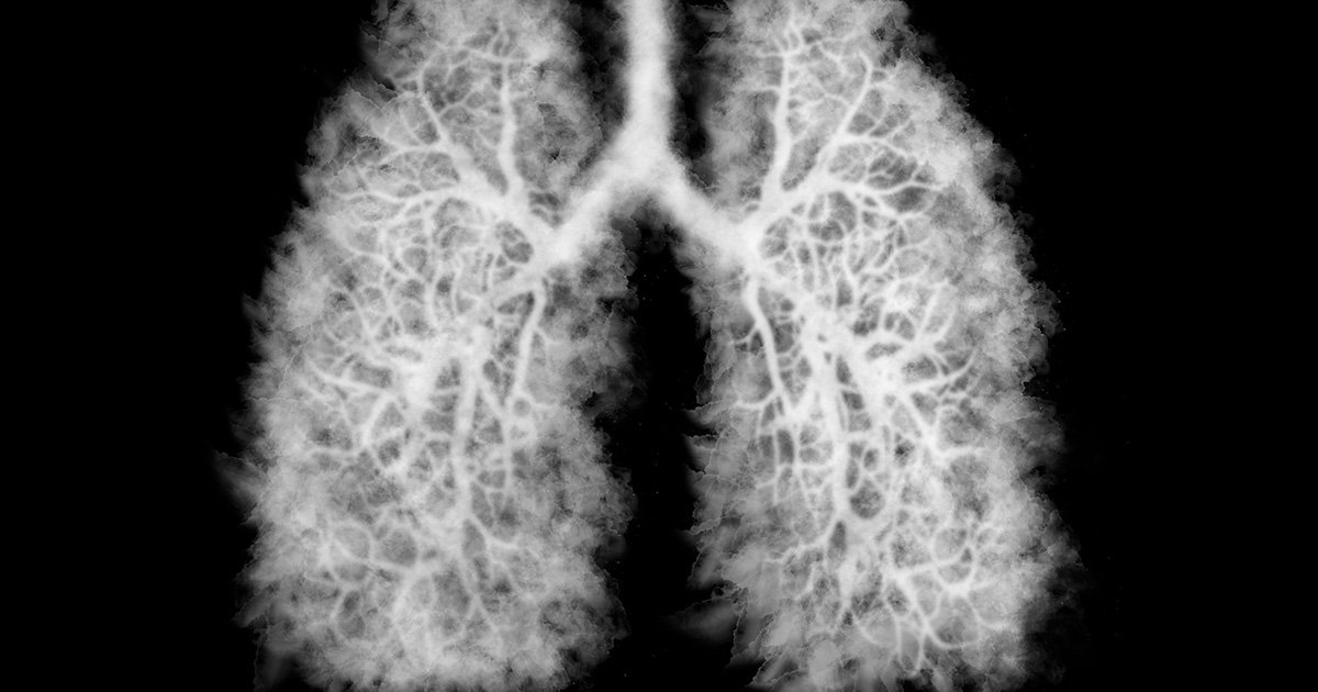 Have y'all ever heard of popcorn lung?

Bronchiolitis obliterans was discovered when popcorn factory workers starting getting sick. The offender was diacetyl, the food additive used to simulate butter flavor.

It is now being seen in users of flavored E-cigs. Diacetyl is