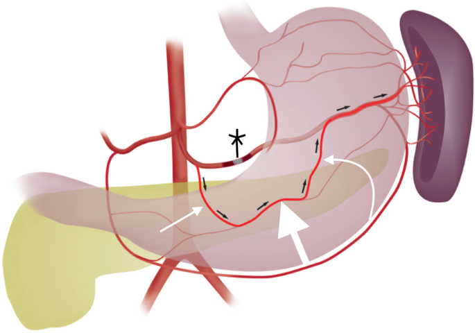 CVIR Endovascular (Jim Reekers, Editor-in-Chief) (@cvirendo) on Twitter photo #SundayRead
This #Review covers literature on splenic embolization indication + technique, comparing + contrasting proximal + distal embolization
Read today for more on relevant anatomy + discuss collateral perfusion pathways after proximal embolization:
cvirendovasc.springeropen.com/articles/10.11… #SundayRead
This #Review covers literature on splenic embolization indication + technique, comparing + contrasting proximal + distal embolization
Read today for more on relevant anatomy + discuss collateral perfusion pathways after proximal embolization:
cvirendovasc.springeropen.com/articles/10.11…