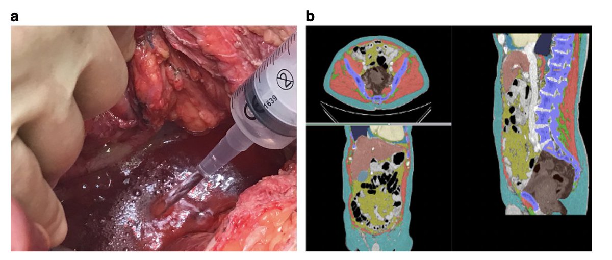 Exenterate The empty pelvis syndrome: a core data set from the @PelvExGroup ...