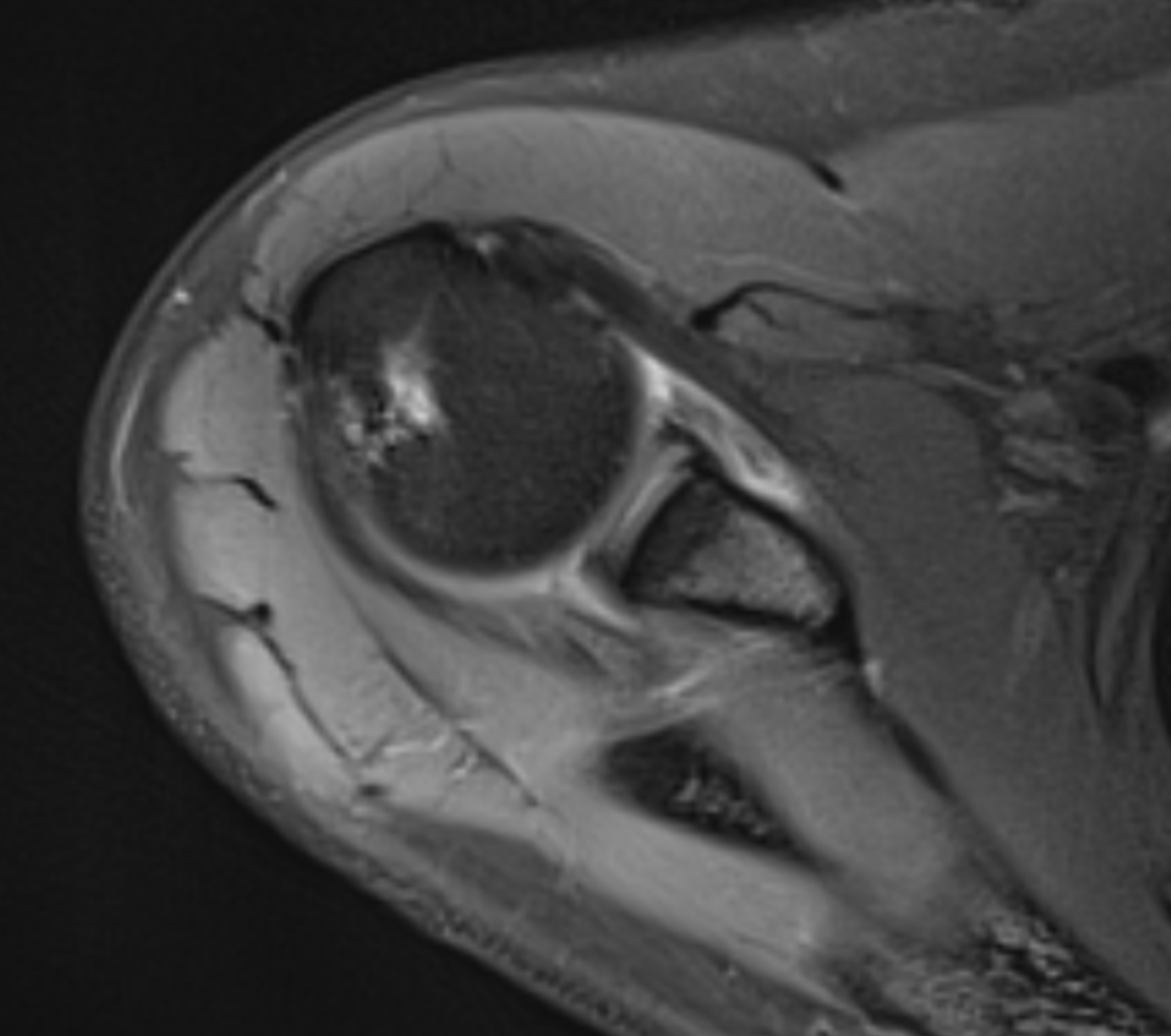 Consent✅

Cross fitter

Worsening R shoulder stiffness (particularly external rotation, HBB, overhead press position) &amp; deep seated aching 

Pain at night

Then pain &amp; 'tightness' spreading to the neck, shoulder girdle, scapula 

Pain radiating down to wrist &amp; hand - also middle
