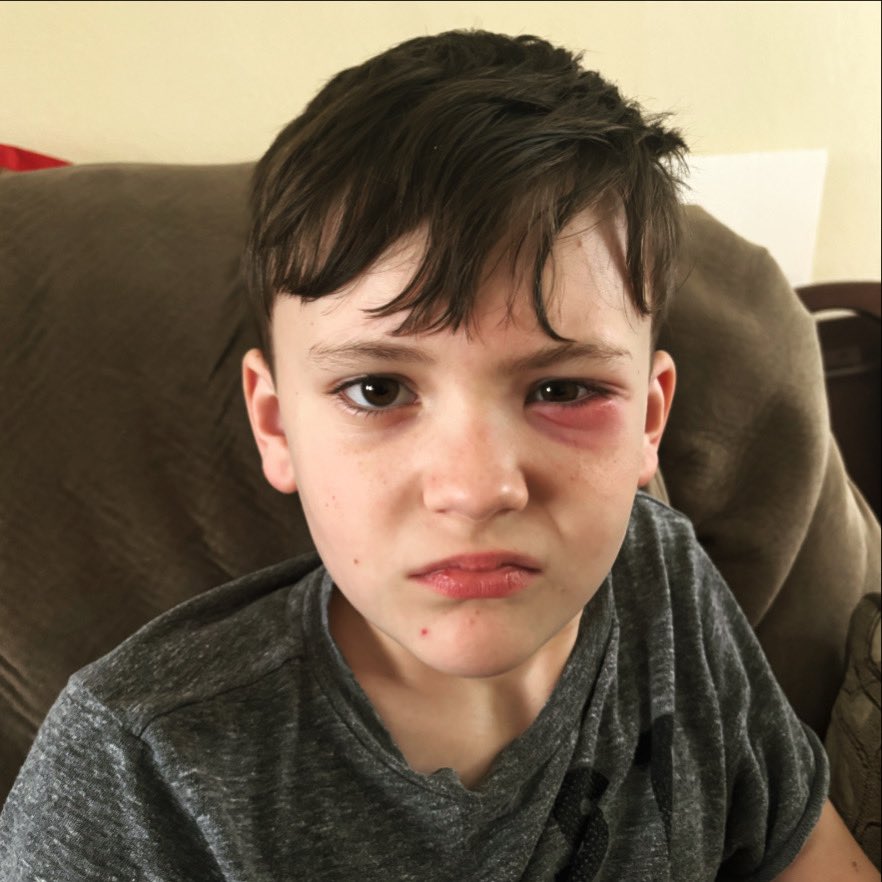 ShannonScheetz's tweet image. 🥊You should see the other guy!! Poor kid dealing with his first stye/eye infection. Putting in the ointment was fun… anyone have a straight jacket we can borrow for few days!! 🤪#andrewmichaelscheetz #alwayssomething #stye