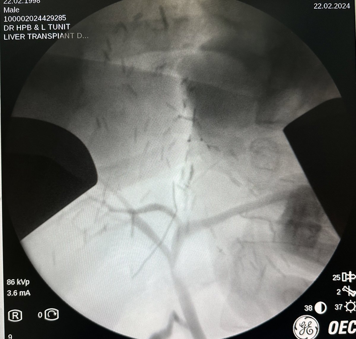 In the last 1 month, 9 out of 10 right lobe living liver donors had type 3 biliary anatomy. Having 2 biliary systems to reconstruct has become the new normal for us. How is your experience? #livertwitter @_LTSI_ @LiverFellow @_ILTS_ @IHPBA