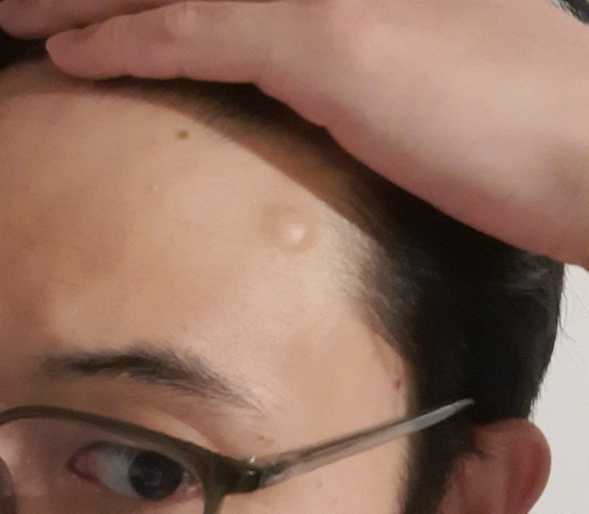 YoshiEnomoto_'s tweet photo. Alnımda şöyle bir şey var. Çıkıntı mı deriz ne deriz bilmiyorum. Tam hatırlamıyorum ama senelerdir var gibi ve yavaş yavaş büyüyor sanki. Kemik gibi sert ve hiç acımıyor. Bu kötü bir şey değil dimi? Ne yapmam gerektiğini söyleyin. https://t.co/ifIYls1xqh