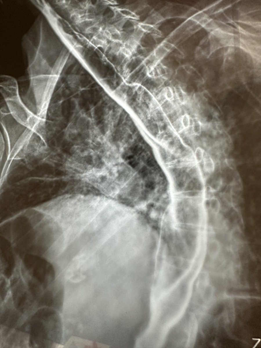hepatologo_RCO's tweet photo. Cambios morfológicos en el #esofago de una paciente con #esclerosis sistémica de larga evolución. #MedX #MedTwitter #GITwitter #GastroTwitter #MedEd #ENARM https://t.co/jOXwcpT89D