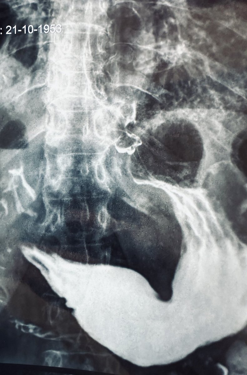 Cambios morfológicos en el #esofago de una paciente con #esclerosis sistémica de larga evolución. #MedX #MedTwitter #GITwitter #GastroTwitter #MedEd #ENARM