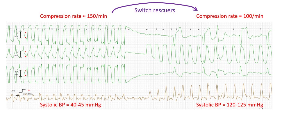 CPR being performed in an ICU setting. Telemetry artifact shows the rate of chest compressions (although not the depth). Arterial line shows the blood pressure achieved during chest compressions.
Quality of CPR makes a difference in perfusion.
#StayinAlive 100/min
<a href="/BenjaminAbella/">Benjamin Abella, MD MPhil</a>
