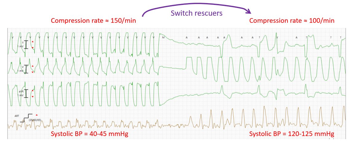 CPR being performed in an ICU setting. Telemetry artifact shows the rate of chest compressions (although not the depth). Arterial line shows the blood pressure achieved during chest compressions. Quality of CPR makes a difference in perfusion. #StayinAlive 100/min @BenjaminAbella