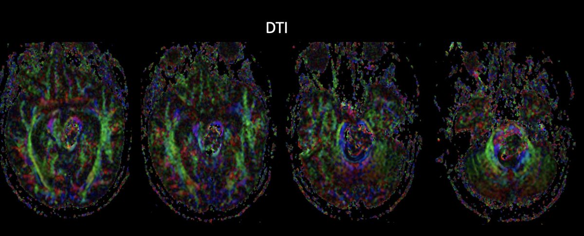 #MorcosChallenge 36F w/ pontomesencephalic cavernoma, bledx2, upgaze/medial/lateral gaze palsy, RUE&RLE 2/5. What are the different surgical options that could be considered &advantages/disadvantages? @EvaWuMD @UTHNeuro @neurosurgatlas @cavernomauk @neuroangioA @medclinicalcase