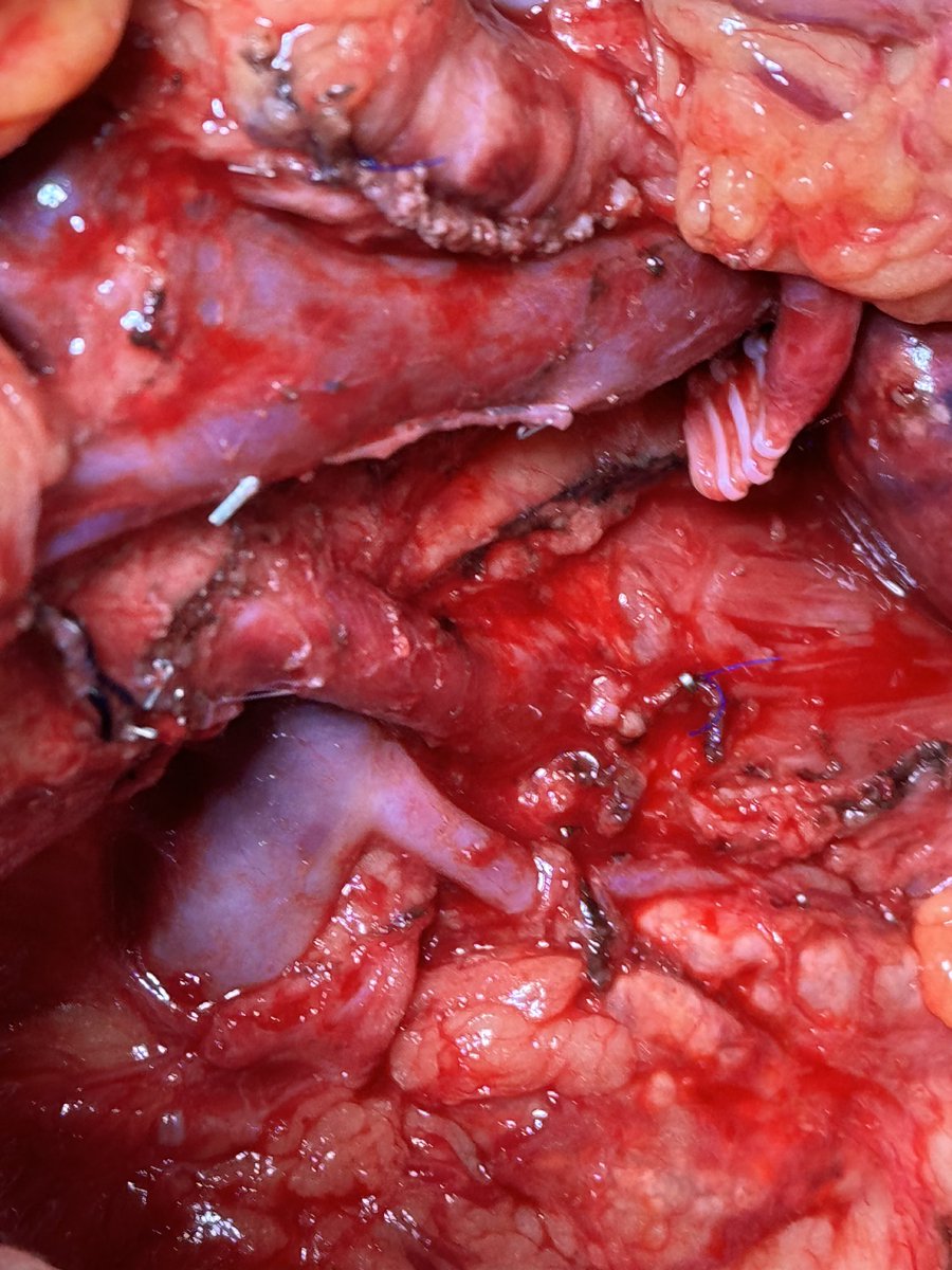 DP-CAR. CHA stump ( 3 hemlocks) MAP was 64 mmHg after clamping, a drop from 78 mmHg. Celiac axis over sutured and clipped. ICG of stomach and liver good perfusion. Modular ant RAMP.