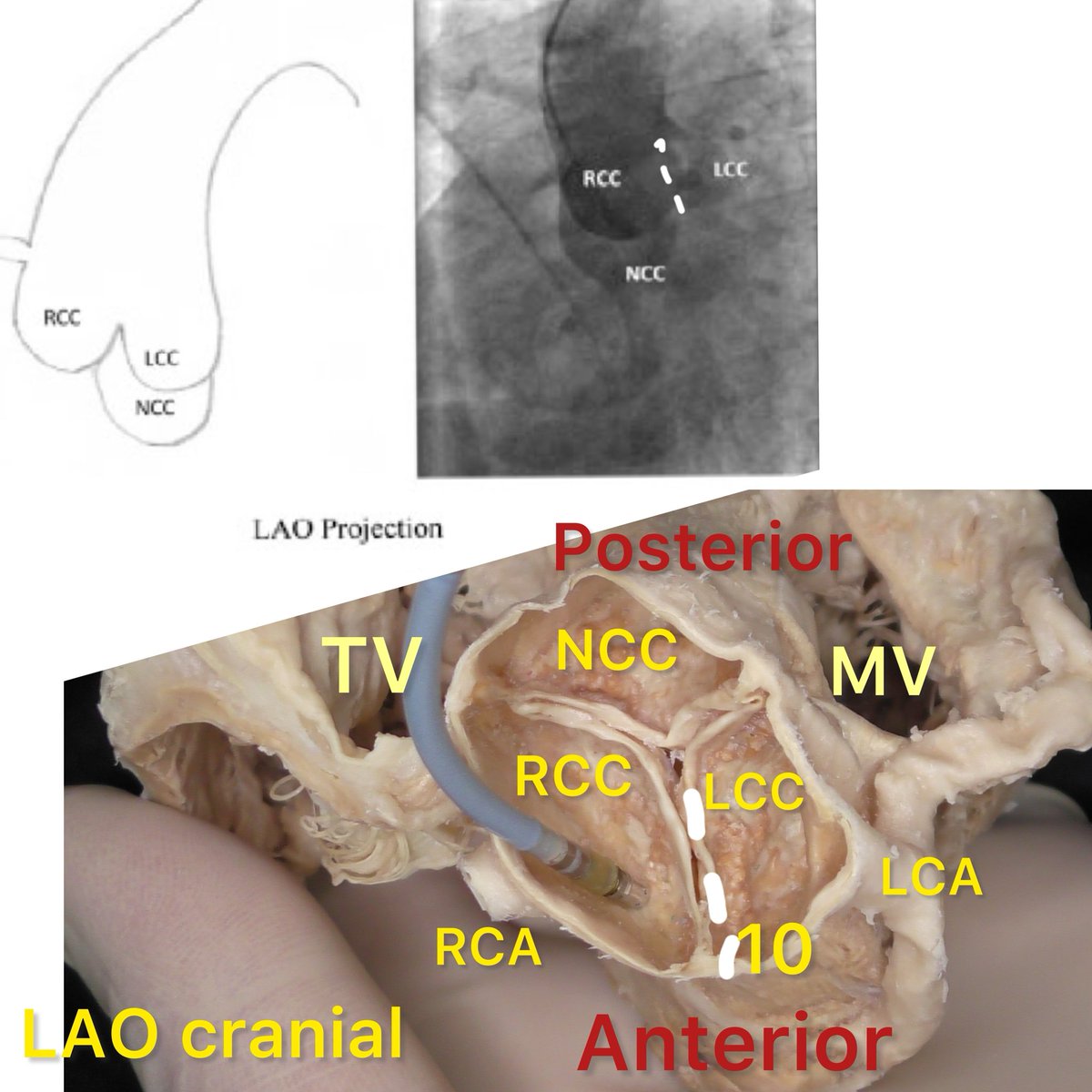 @alex1708ander @ChristianHeeger Thank you very much for your comment. I took the images in the LAO cranial view as I often work with LAO in fluoroscopy. I see the heart in LAO from an anterior perspective. Surgeons view the heart from a posterior perspective through the atria. Here is a brief description of…