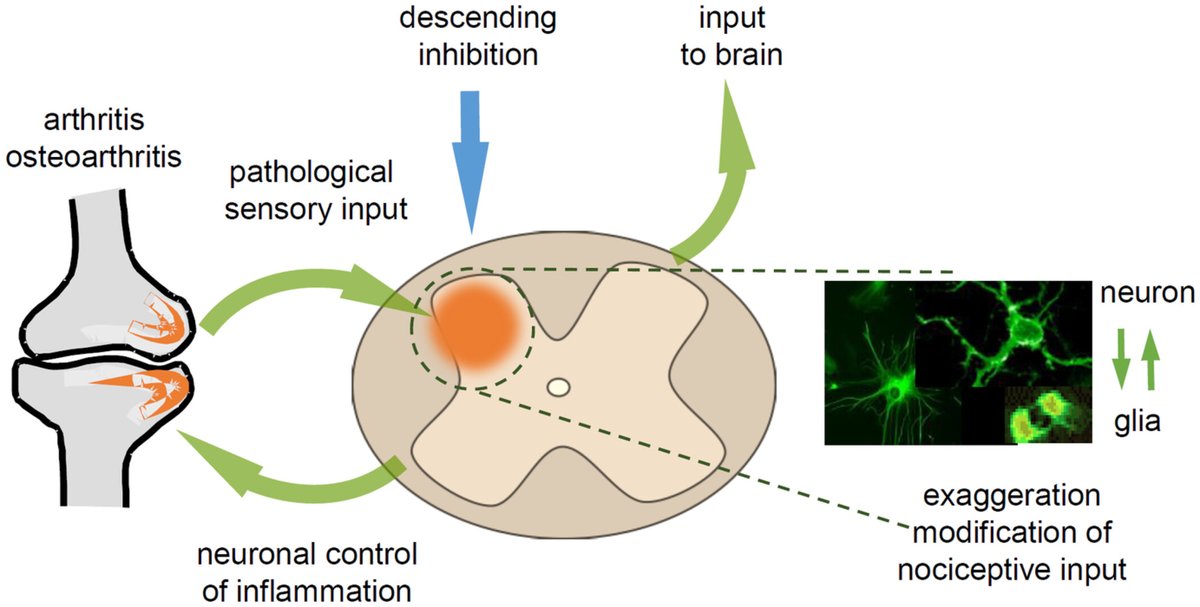 PhysioMeScience's tweet photo. Spinal pain processing in arthritis: Neuron and glia (inter)actions

https://t.co/gNrlHwYXiq https://t.co/SBdcNf5Xi0