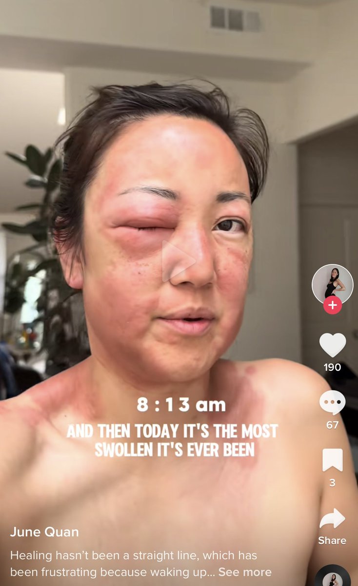 This poor woman is documenting her rapid daily decline what looks like mRNA injury and basically she says doctors are baffled. @MakisMD @JonelessHomes