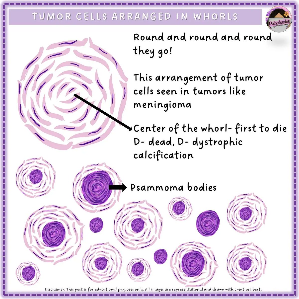 #pathodoodles way to understand how and where of Psammoma bodies for #MedicalStudentTwitter #MedEd #PathTwitter #USMLE #NEET #inicet