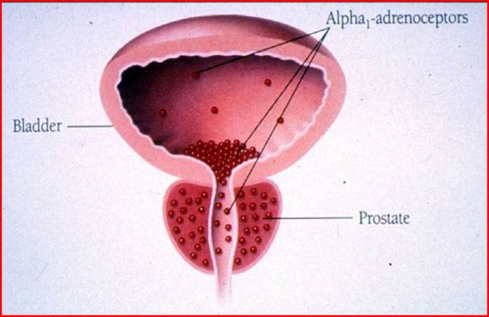 Treating BPH: -Most common initial therapy includes alpha 1 antagonist (terazosin, doxazosin, etc.) How? Relaxes smooth muscle at the bladder neck and prostate, giving relief to an obstruction. Most common side effects: hypotension, retrograde ejaculation, rhinitis