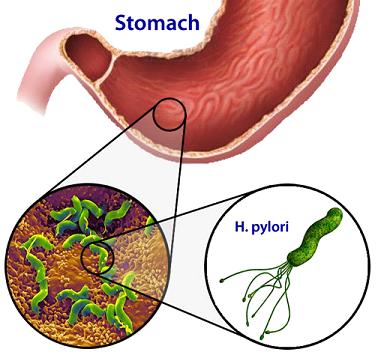 DannyD21100's tweet photo. Stomach ulcers are often linked to the bacterium Helicobacter pylori, which can lead to complications when fasting. The absence of food and the increase in gastric acid production during fasting can aggravate symptoms and hinder the healing process. https://t.co/gQioUOwRQ4