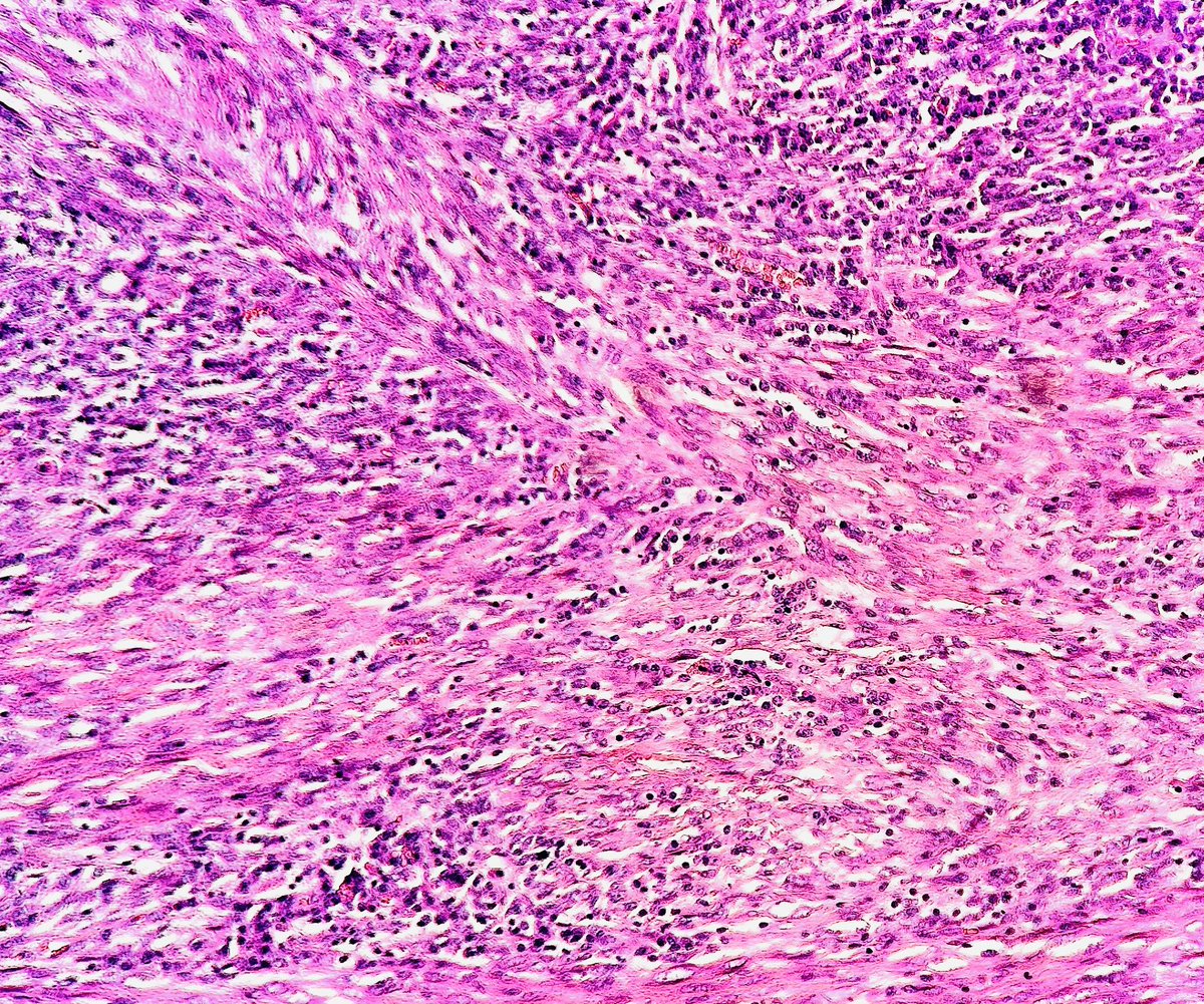 I am a myofibroblastic tumor of borderline malignancy

I may arise in many organs (eg lungs, bladder, omentum)

I often have a lymphoplasmacytic infiltrate, can be ALK+ and can present w night sxs

Who am I?

#pathagonia #pathx #bstpath #hemeonc #orthox #surgpath #orthoonc #msk