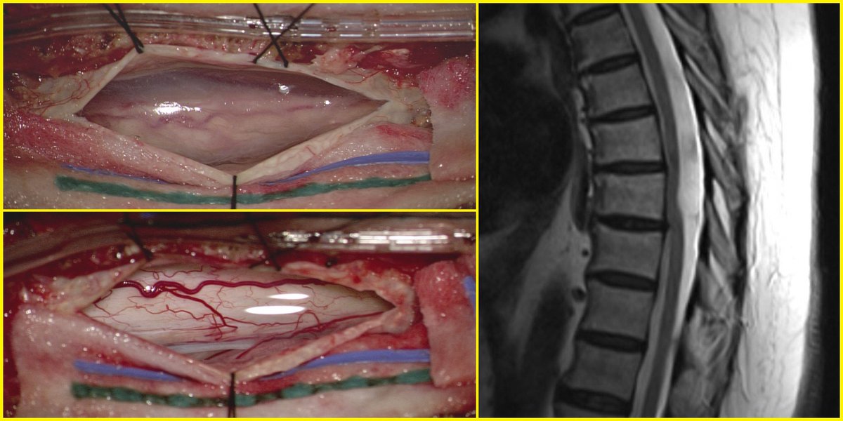 before and after sub- arachnoid web ressection 
source Ali A baaji MF