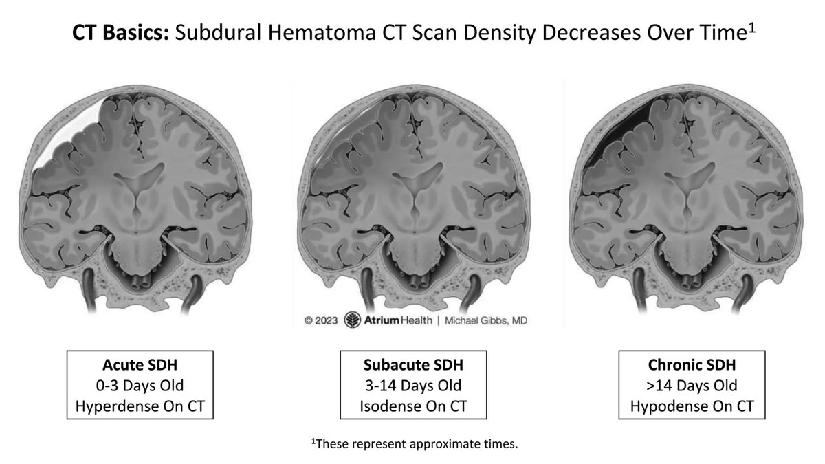 Check out our latest Neuroimaging case on subdural hematomas. #MedEd #MedTwitter #FOAMed #Radiology litfl.com/neuroimaging-c…