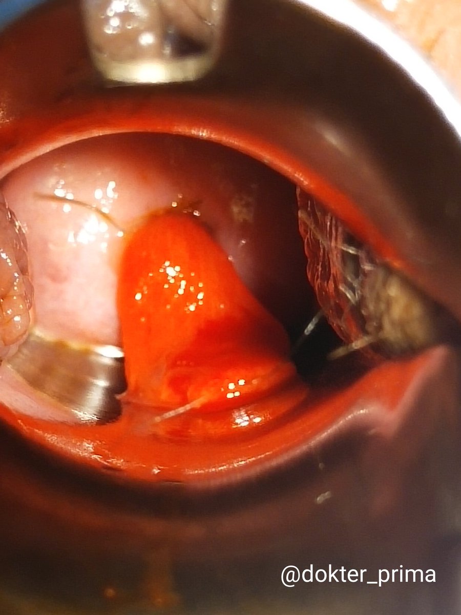 Dr. Prima P,SpOG,MPH tweet media