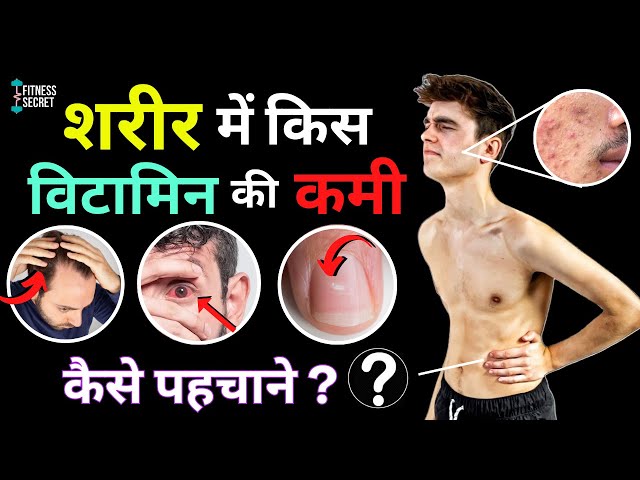 हमारी बॉडी समय -समय पर हमें सिग्नल देती है,कि हमारे बॉडी में कौन-कौन से विटामिन और मिनरल्स की कमी है,
अगर हम इसके प्रति जागरूक रहें तो हम इसे आसानी से पहचान सकते हैंI
इस पोस्ट में हम (Part-1)कुछ विटामिन और मिनरल्स की कमी के लक्षण को देखेंगे ,
अगले पोस्ट में (Part-2)इसके उपचार तथा