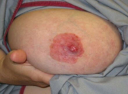 Path4People's tweet photo. I arise in the nipple-areolar area with eczematous or erythematous change

I am oftentimes associated with a high grade DCIS or invasive cancer

I am HER2 + 

Who am I?

#pathagonia #breastpath #breastx #medstudentx #medstudent #usmle #dermpath #derm #dermx #pathx #fammed #medx https://t.co/GlDv1MREap