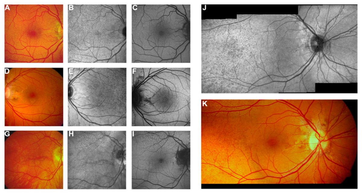 vision_mdpi's tweet photo. 💐New published Review by Dr. Tsokolas and Dr. Panos et al. from @UHD_NHS, @nottmhospitals 
👉Angioid Streaks Remain a Challenge in Diagnosis, Management, and Treatment
🔍https://t.co/kRndxda8oo https://t.co/4mpFU24r8B