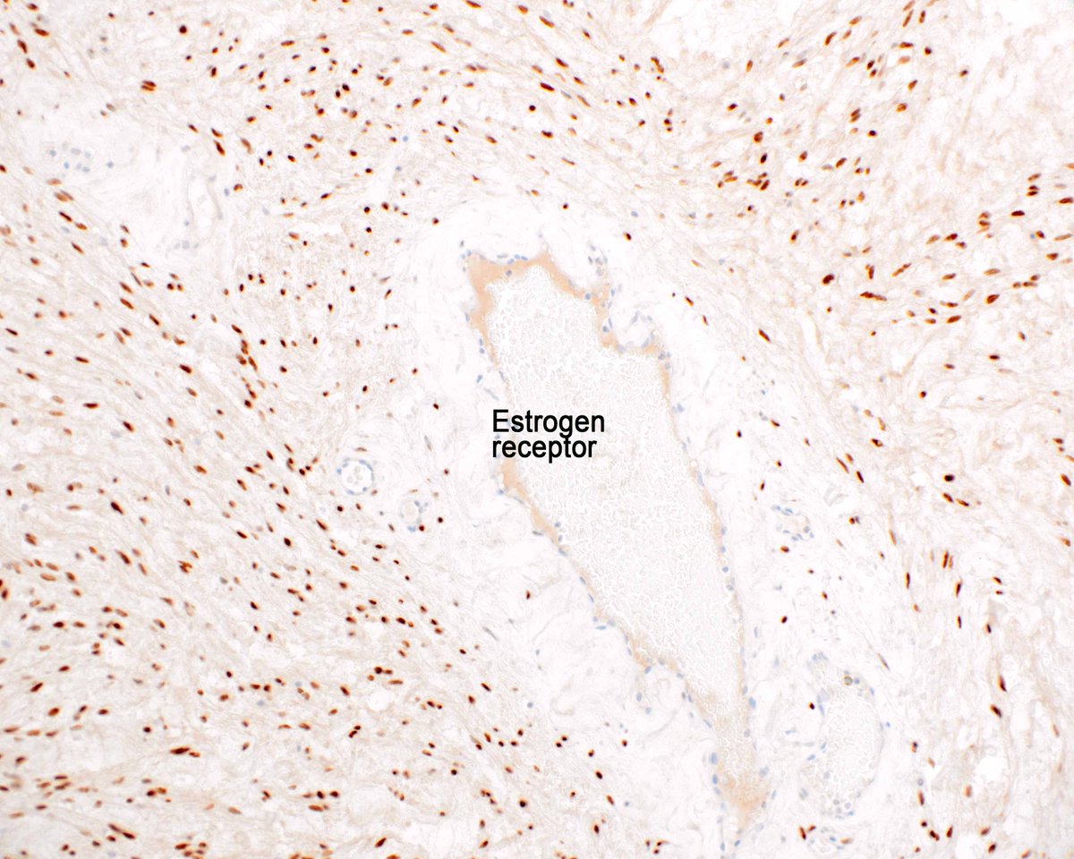 Benign cellular angiofibroma. It was initially described as 'angiomyofibroblastomalike tumor of the male genital tract' but they can arise in women. The thick hyalinized blood vessels are typical. This example arose in a man. Vintage reference: PMID: 9422311. #UMiamiPath