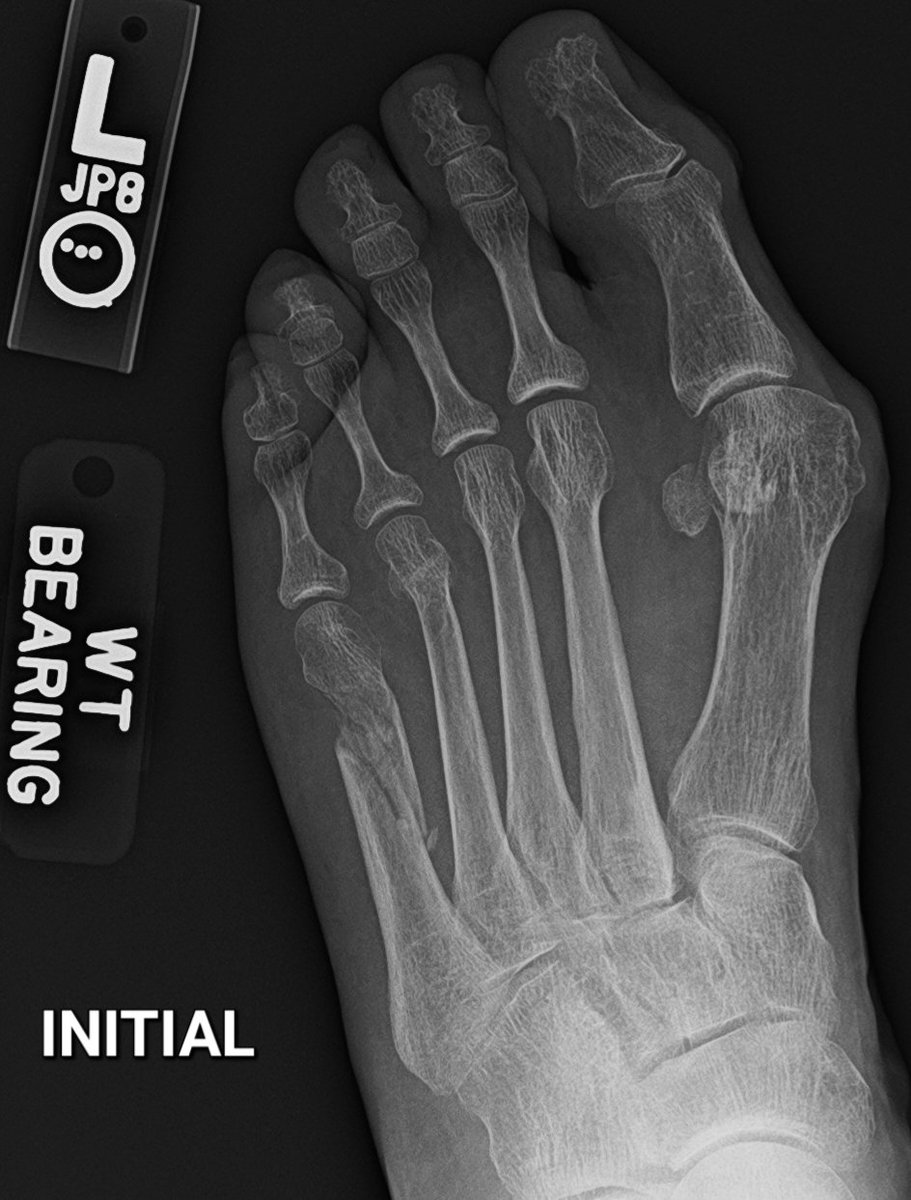 #CaseOfTheWeek🎉

📢✅Answer for Case #9: Frieberg disease

*Subtle flattening and sclerosis of the 2nd metatarsal head*

Have a great week!!🥳🎉

#FOAMrad #RadEd #MedEd #OrthoEd #OrthoTwitter <a href="/ssr_rwg/">SSR_RWG</a> <a href="/UWRadRes/">UWisconsin Radiology Residents</a> <a href="/AOFAS/">AOFAS</a>