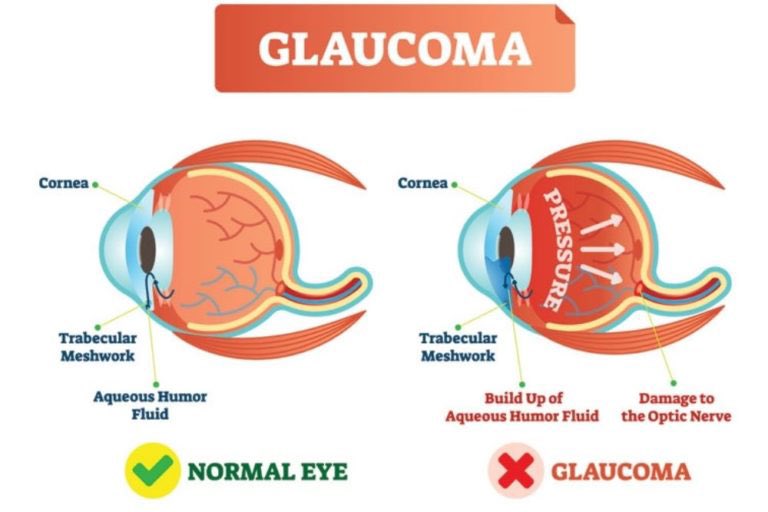 GabrielAgbeshie's tweet photo. GLAUCOMA (SILENT THIEF OF SIGHT)

What is it and how can it be managed?👇 https://t.co/AWcJdmWLSE