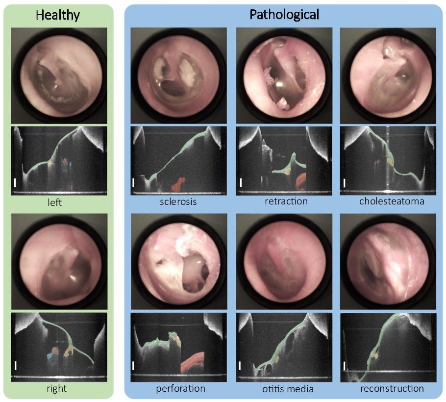 📢Glad to share our latest publication @ScientificData. Introducing DIOME dataset: 43 OCT image volumes of healthy and pathological middle ears, complete with anatomical segmentation masks. 📄 Paper: nature.com/articles/s4159… 💿 Dataset: doi.org/10.25532/OPARA…