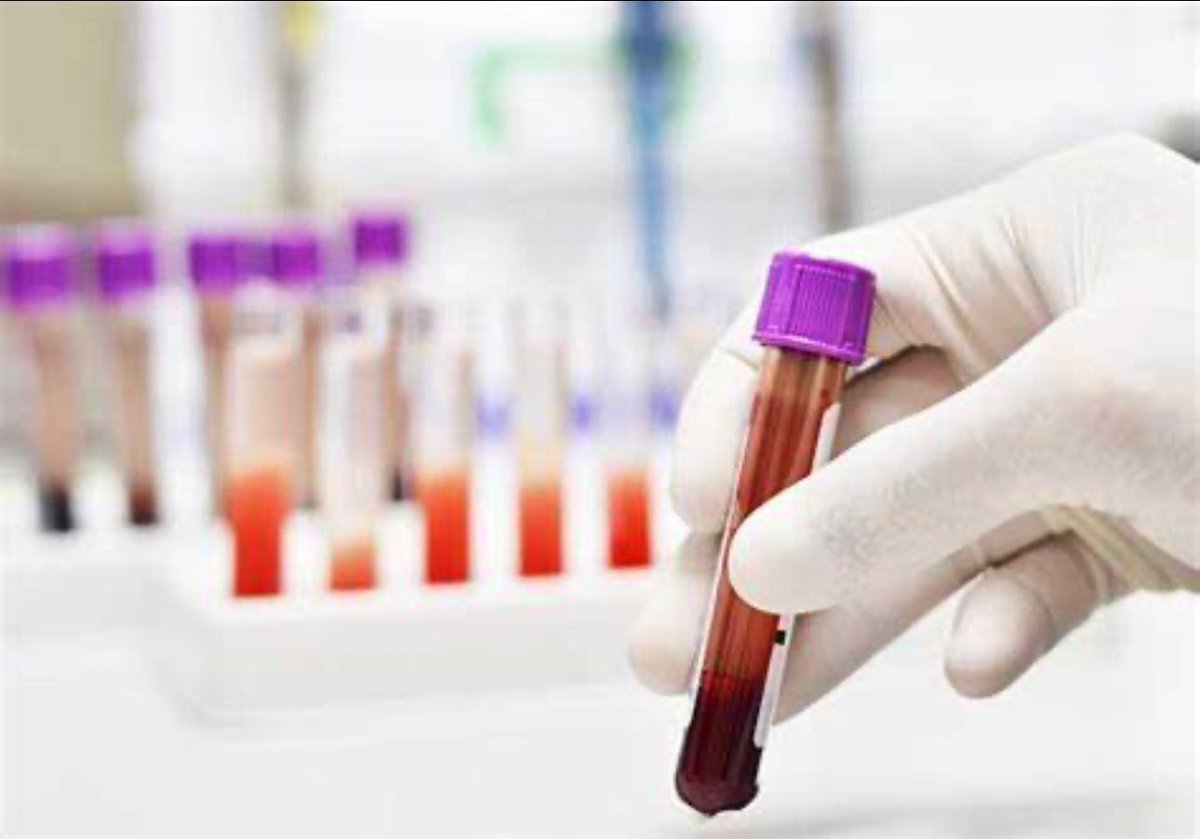 Spine Research - RUSH University (@isriirush) on Twitter photo 🔥🔥Discovery of blood biomarkers associated with potential “vertebrogenic” origins of back pain in patients by <a href="/khaledboushaala/">Khaled Aboushaala</a>, Howard S. An, Dino Samartzis et al
link.springer.com/article/10.100…
<a href="/EurSpineJournal/">European Spine J</a> <a href="/DinoSamartzis/">Dino Samartzis</a> <a href="/RUOrthoResearch/">RUSH Orthopedic Research</a> <a href="/OrsSpineSection/">ORS Spine Section</a> <a href="/ISSLS_Society/">ISSLS</a> 🔥🔥Discovery of blood biomarkers associated with potential “vertebrogenic” origins of back pain in patients by <a href="/khaledboushaala/">Khaled Aboushaala</a>, Howard S. An, Dino Samartzis et al
link.springer.com/article/10.100…
<a href="/EurSpineJournal/">European Spine J</a> <a href="/DinoSamartzis/">Dino Samartzis</a> <a href="/RUOrthoResearch/">RUSH Orthopedic Research</a> <a href="/OrsSpineSection/">ORS Spine Section</a> <a href="/ISSLS_Society/">ISSLS</a>