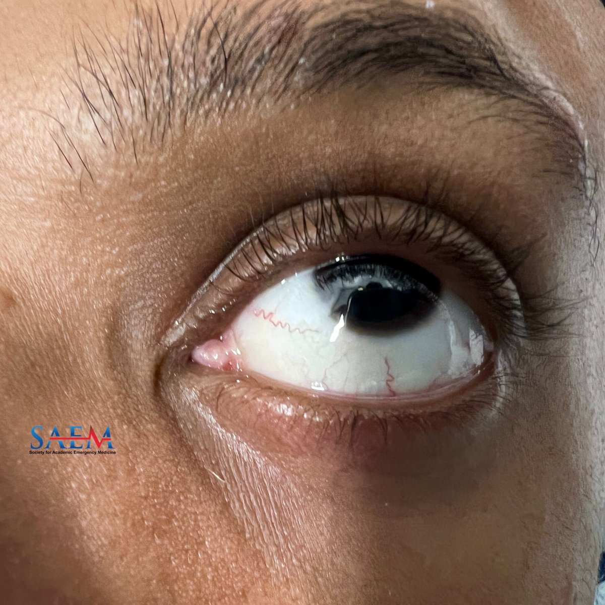 SAEM Clinical Images Series: Not Your Usual Irritated Eye Eye irritation in the setting of facial rash requires a full eye exam for possible ocular involvement. aliem.com/saem-clinical-…