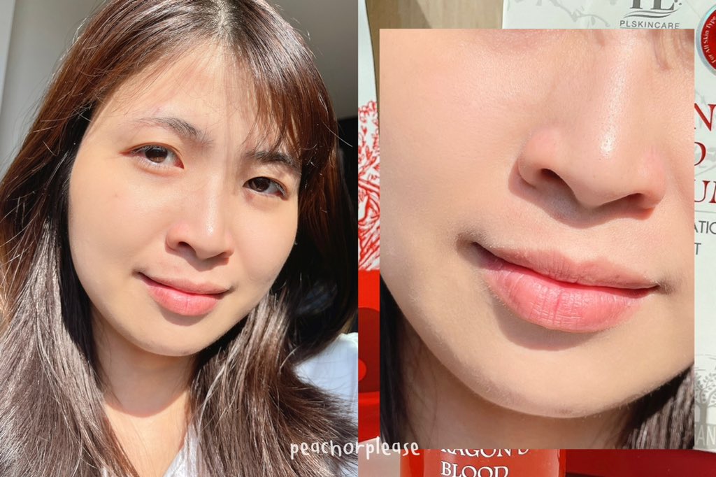 เซทนี้เป็นสบู่กับเซรั่มของ PL Skincare ช่วยเรื่องสิวต่างๆ ไม่ว่าจะเป็นสิวจากปจด. สิวอุดตัน สิวซ้ำซากก็ใช้ได้ ล้างหน้าเสร็จทาเซรั่มต่อทั้งเช้าเย็นไม่มีสิวมากวนใจ 🫶🏻 สบู่ล้างหน้าสะอาดเกลี้ยง หน้าไม่แห้งตึง เนื้อเซรั่มบางเบาทาง่ายซึมเข้าผิวเร็วด้วย