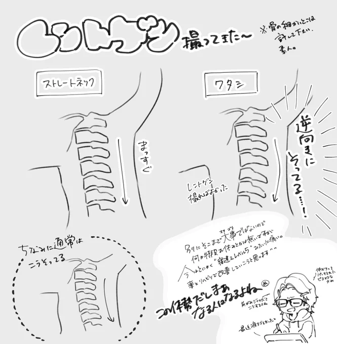 首の痛みに耐えらんなくなって整形外科行ったら、こう、、私は首がこう、らしい  所謂ストレートネックどころじゃなかったらしいな  出来ればリハビリ続けてだってさ  へへ でも痛み無ければ問題ないので仕事はするよ〜 