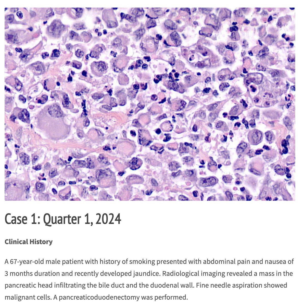 The #PBPS Case of the Quarter is now available! 67 yo male with pancreatic head mass - what's your diagnosis? Read on for a great discussion! #pancreas pbpath.org/case-1-quarter…
