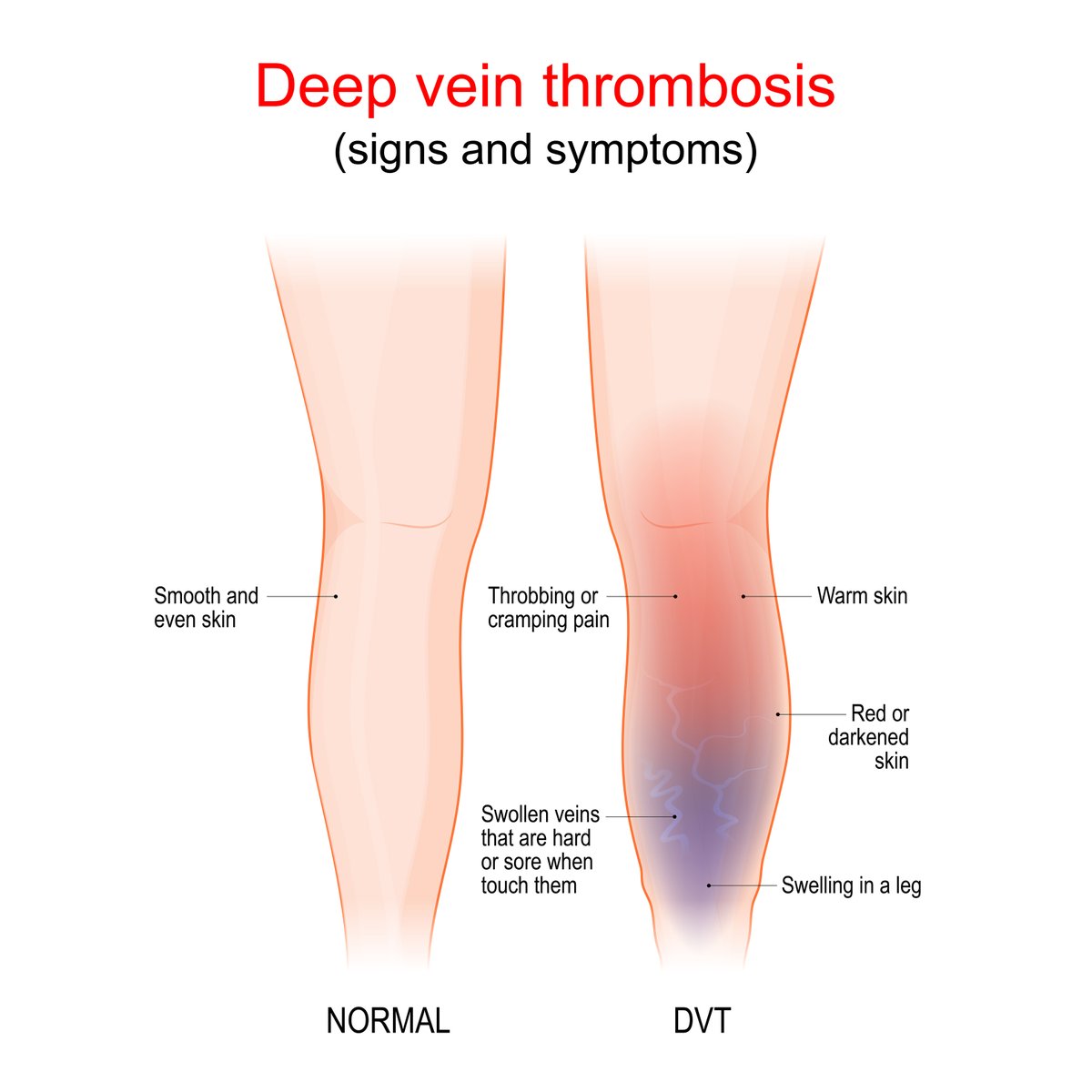 March is #DeepVeinThrombosis Awareness Month! Did you know in #APS, blood clots can occur in both arteries & veins? DVT, common in APS, causes painful swelling. This month, let's raise awareness about the signs, symptoms, and prevention. Your awareness could save a life! #DVTAM