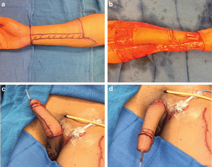 againstgrmrs's tweet photo. This is what is done to girls to create a fake penis. They take the skin from the forearm or thigh to use for the new appendage. https://t.co/m6NWepusFe