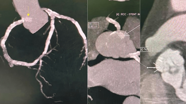 radcliffeCARDIO's tweet photo. 📚New #ICRJournal Article: "Consequences and Management of Excessive Ostial Stent Protrusion"
📚 Just Published!
🔓Access it here 👉 https://t.co/95bdRqGX7S
#CVImaging #MedEd https://t.co/nv0e87GlCr