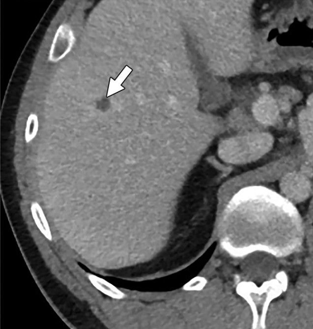 Importancia de la TC dual en la caracterización de lesiones hepáticas focales hipodensas inespecíficas. Traemos el #ArtículoRecomendadoDelLunes 🕵 ➡️ buff.ly/4a619gZ #FOAMrad #FOAMed @SERAM_RX @sediabdomen SERAM - Sociedad Española de Radiología Médica.