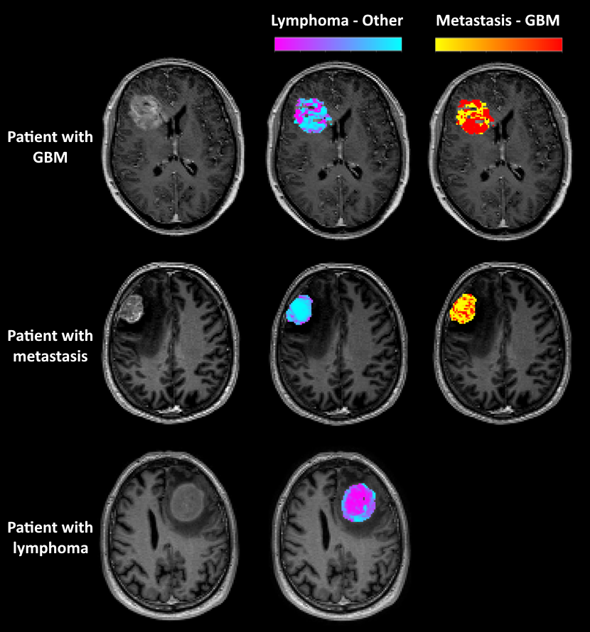 📢 Exciting news from our group @RadiomicsVHIO & @HUBellvitge! 🧠We have developed a tool to differentiate between different types of neurological tumors using MRI data. 📎 Paper (Cell Reports Medicine): doi.org/10.1016/j.xcrm… 👩‍💻 Code: github.com/radiomicsgroup…
