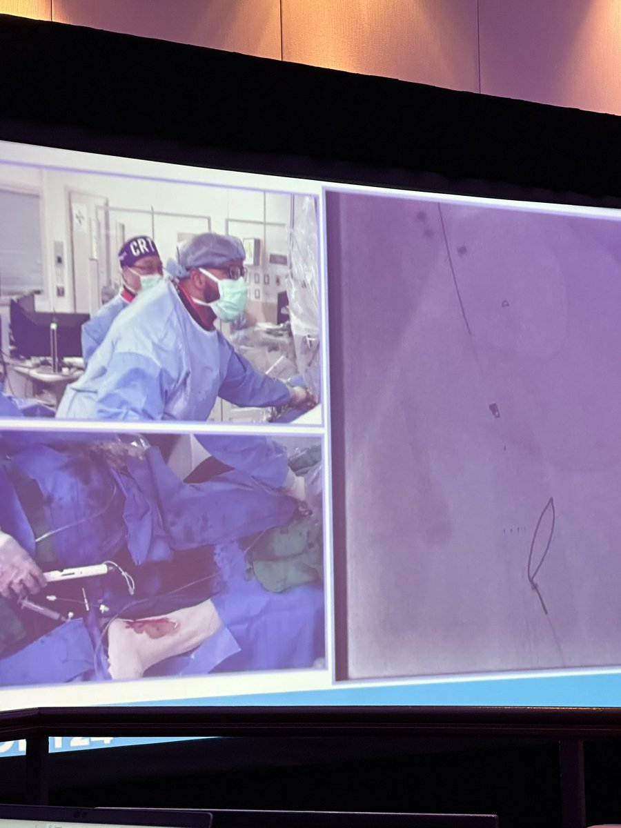 michaelcsiah's tweet photo. Watching @KReyMD and Dr. Bernardo do a slick Detour case at #CRT2024 is giving me residency flashbacks ❤️ #lovetoseeit #multidisciplinarycare https://t.co/ZhLgSkcFLC