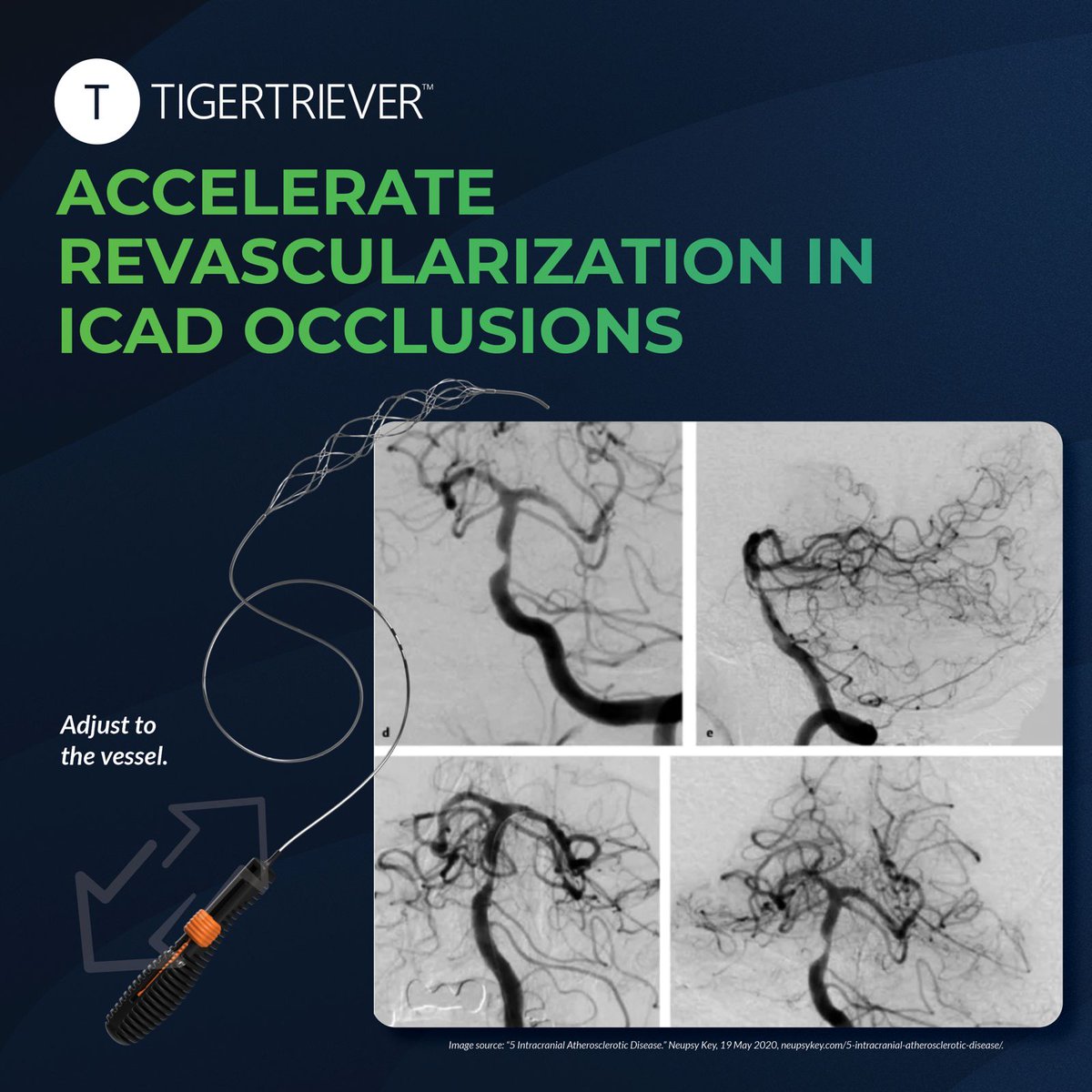 Rapid__Medical's tweet photo. Passing through ICAD occlusions is difficult for static devices. TIGERTRIEVER™ can adjust to the vessel narrowing and has been shown to provide an angioplasty-like effect to successfully restore blood flow. https://t.co/oGUAdKFCjE #ExpandWhatsPossible #RapidMedical https://t.co/0IelX1DuZs
