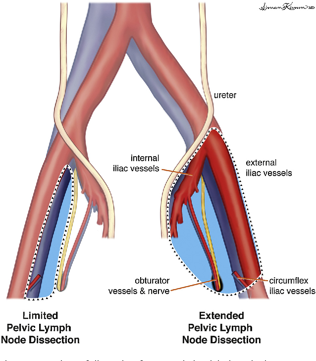 Pelvic lymphadenectomy in radical prostatectomy has not shown consistent evidence of therapeutic oncologic benefit. Node dissection helps with staging and future management, but frequency of complications such as vascular injuries and post-op lymphoceles can be increased.