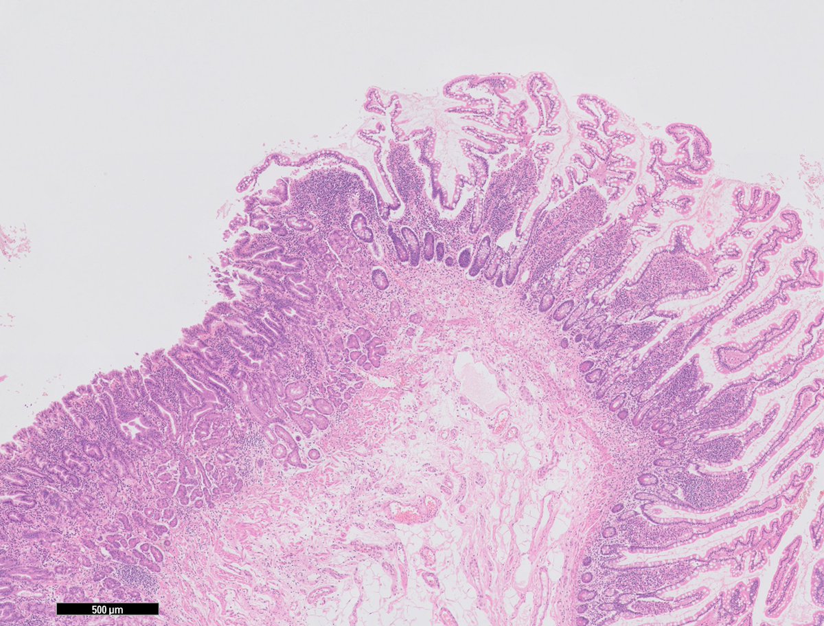 What is present in approx 2% of the population?